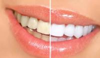 documenti/GhTlP-sbiancamento-denti.jpg